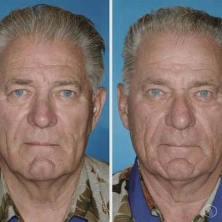 Study of twins shows smoking damage
